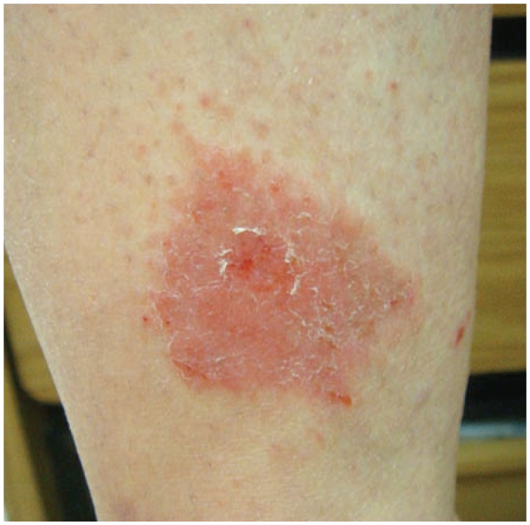 Acute allergic contact dermatitis showing erythema, vesiculation, and linear pattern from poison ivy exposure