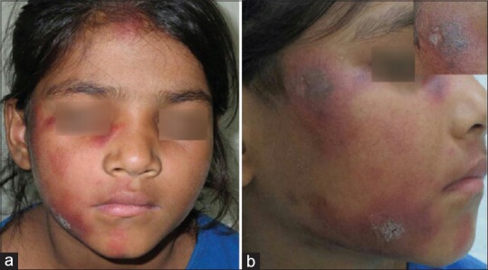 Clinical photograph of discoid lupus erythematosus showing erythematous plaques with scarring on the face
