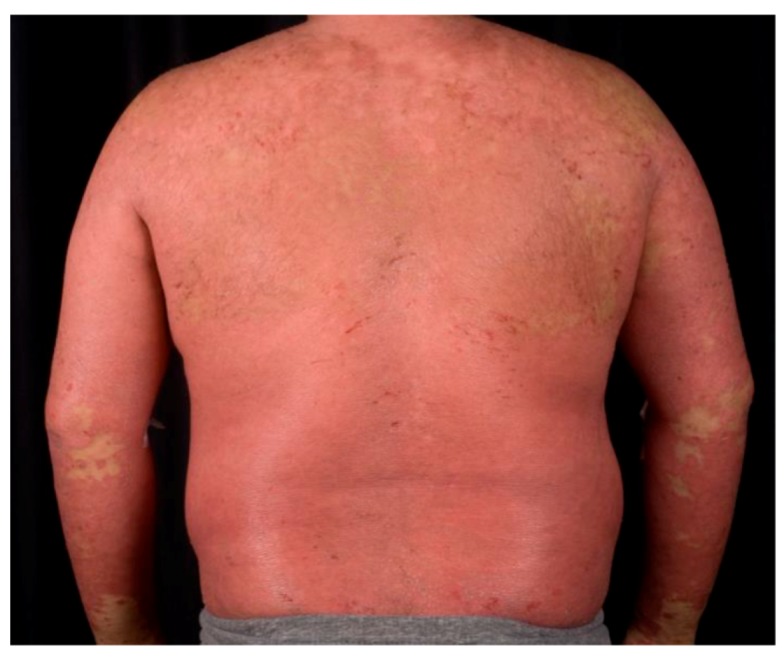 Clinical photograph of erythrodermic psoriasis with greater than 90% body surface area involvement