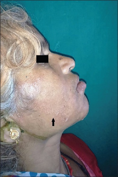 Clinical photograph of herpes zoster showing grouped vesicles in a dermatomal distribution