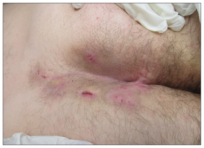 Clinical photograph of hidradenitis suppurativa showing nodules, abscesses, sinus tracts, and scarring in the gluteal region