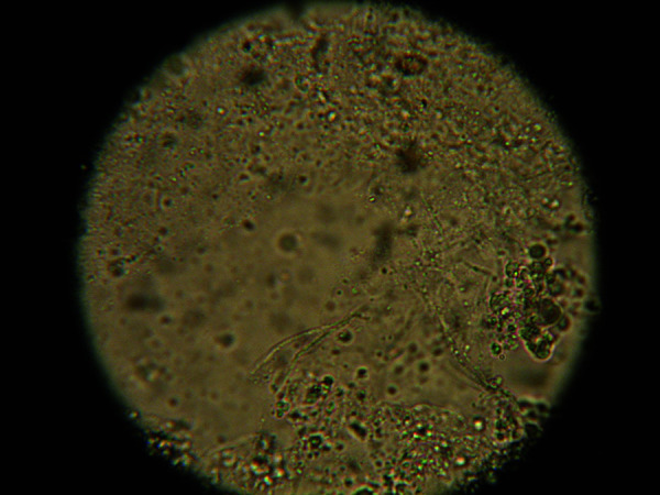 KOH preparation under microscopy showing branching septate hyphae of dermatophyte infection