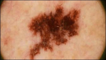 Dermoscopic image showing atypical pigment network with irregular streaks in a melanocytic lesion