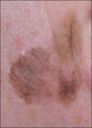 Clinical photograph of lentigo maligna melanoma showing an irregularly pigmented patch on sun-damaged facial skin