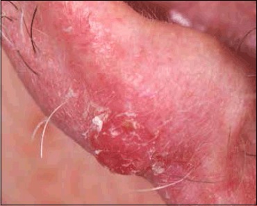 Clinical photograph of nodular melanoma presenting as an erythematous nodule