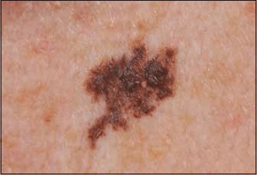 Clinical photograph of superficial spreading melanoma showing asymmetry, irregular borders, and color variation