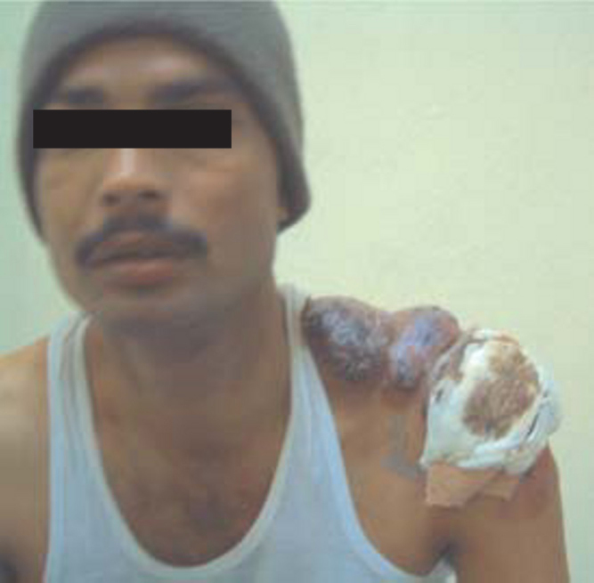 Clinical and histopathological images of mycosis fungoides showing patch-stage cutaneous T-cell lymphoma