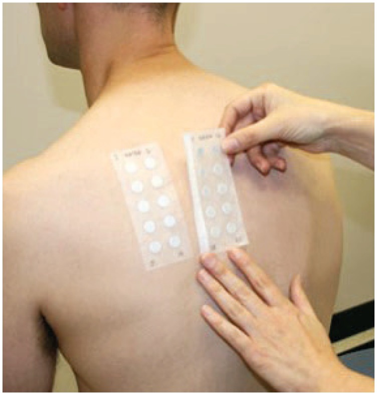 Patch test allergen panels applied to a patient's upper back for evaluation of allergic contact dermatitis