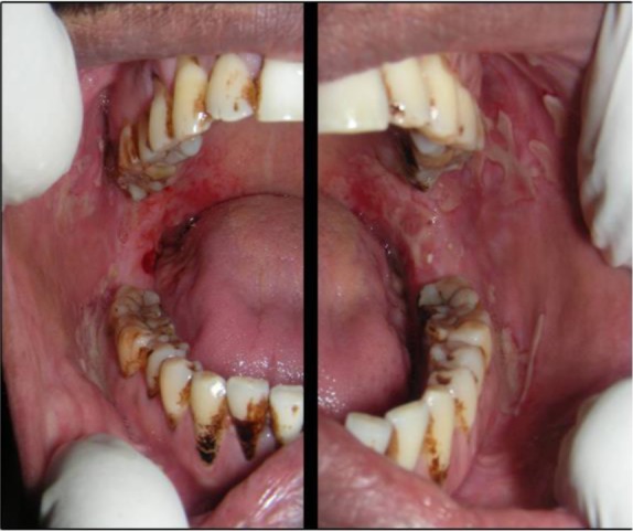 Intraoral photograph showing erosive lesions of pemphigus vulgaris on the buccal mucosa