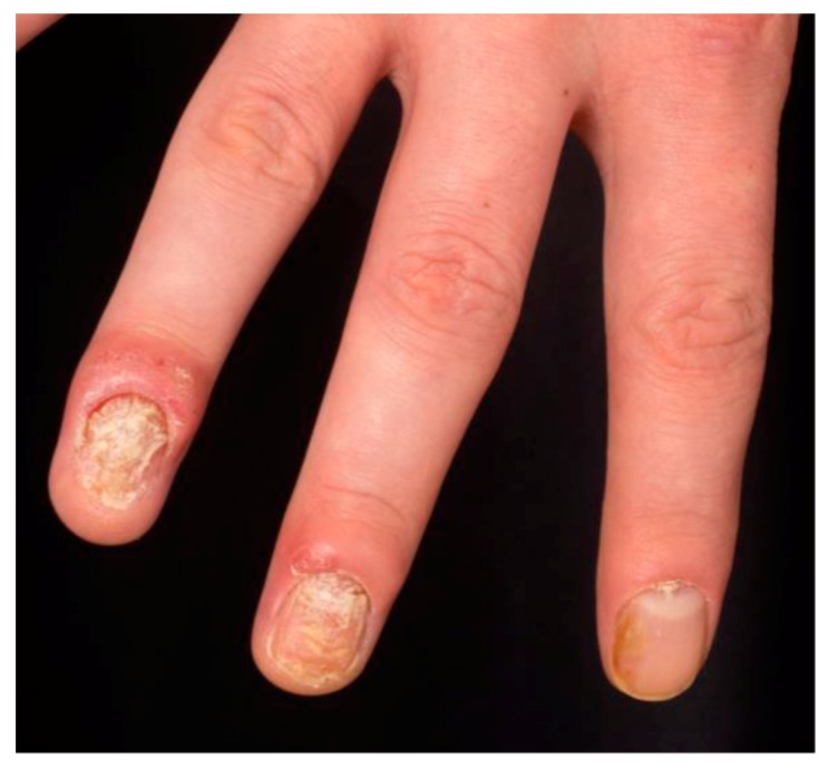 Clinical photograph of nail psoriasis showing pitting, oil-drop spots, and onycholysis