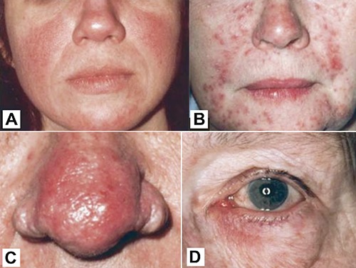 Clinical photographs showing the four subtypes of rosacea: erythematotelangiectatic, papulopustular, phymatous (rhinophyma), and ocular