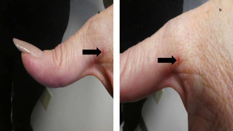 Clinical photograph of scabies burrows near the thumb web space