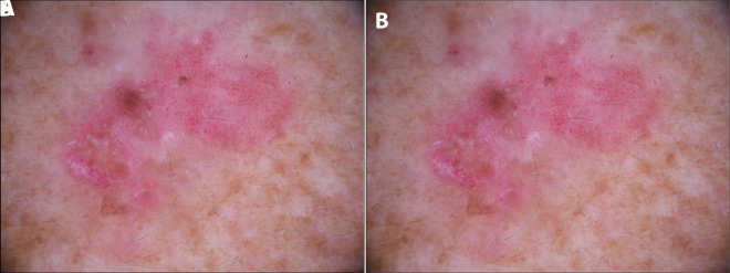 Clinical and dermoscopic images of Bowen disease (squamous cell carcinoma in situ)