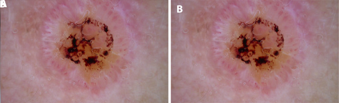 Clinical photograph of well-differentiated cutaneous squamous cell carcinoma on the nose