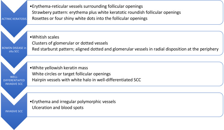 Dermoscopic progression model showing features of actinic keratosis to invasive squamous cell carcinoma