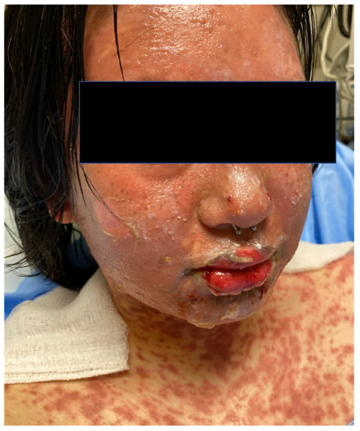 Clinical photograph of toxic epidermal necrolysis showing dusky macules, epidermal detachment, and mucosal involvement on the face