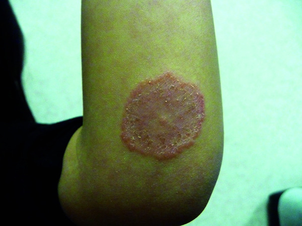 Clinical photograph of tinea corporis showing annular plaque with central clearing and raised scaly border