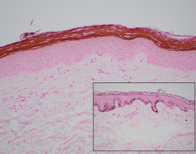 Histological image with Fontana Masson stain showing absence of melanin in vitiligo skin compared to normal skin