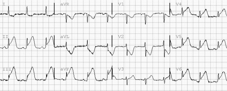 ECG diagnosis and classification of acute coronary syndromes showing STEMI, NSTEMI, and unstable angina patterns