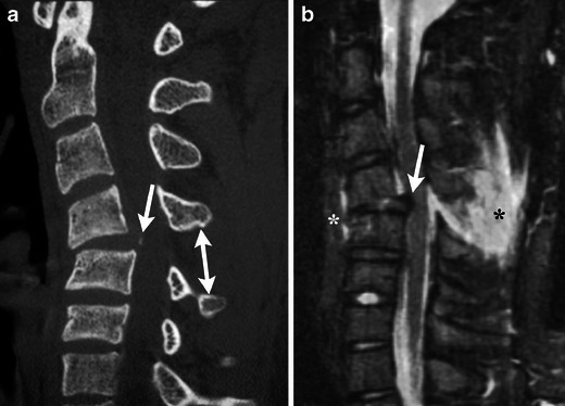 CT cervical spine showing facet dislocation with subluxation and spinal canal compromise