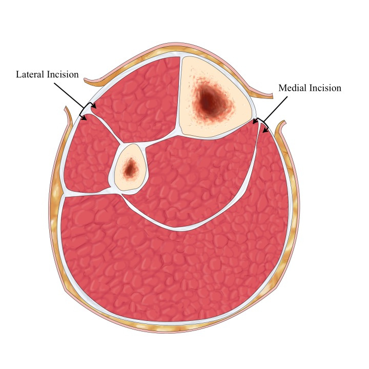 Surgical technique for four-compartment fasciotomy of the lower leg showing incision locations and compartment decompression