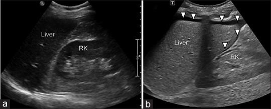 Positive FAST exam LUQ view showing free fluid in the splenorenal recess between spleen and left kidney