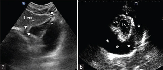Positive FAST exam showing free fluid in Morison's pouch between liver and right kidney