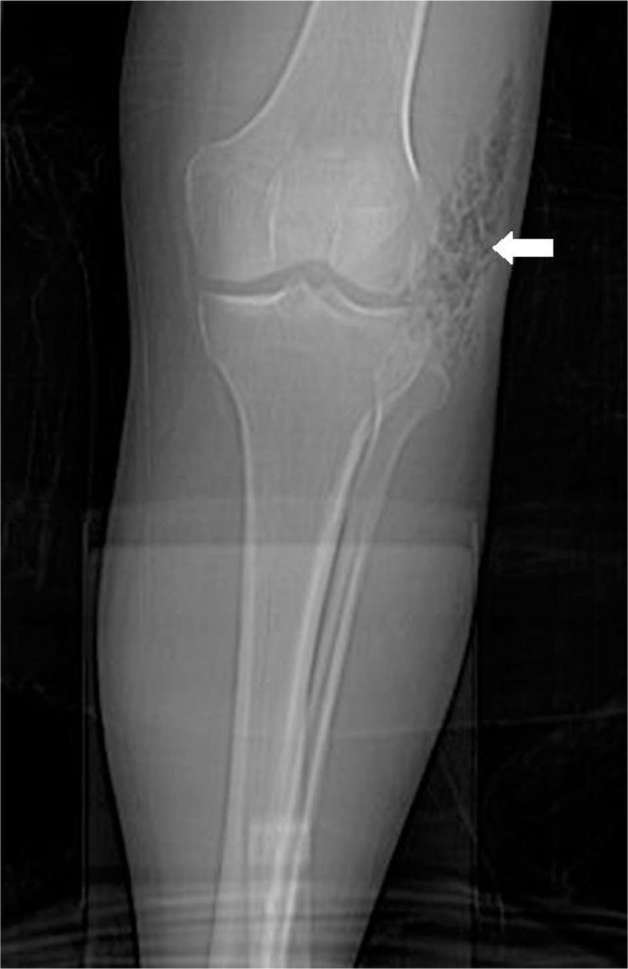Imaging findings in necrotizing fasciitis showing fascial thickening, fluid collections, and tissue gas on CT and MRI