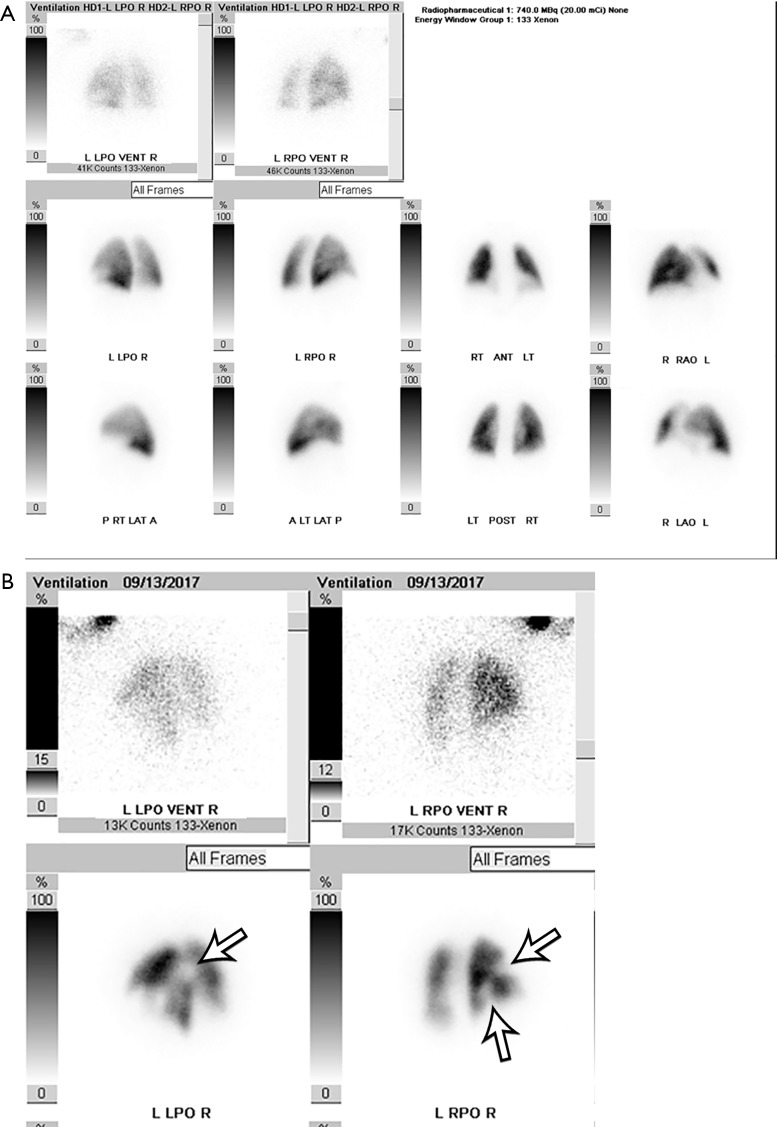 CT pulmonary angiography demonstrating various PE presentations including central, segmental, and subsegmental emboli