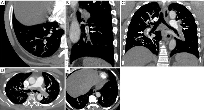 CT showing right ventricular enlargement and strain in massive pulmonary embolism