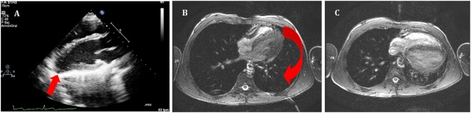 Echocardiographic evaluation showing pericardial effusion with fluid surrounding the heart