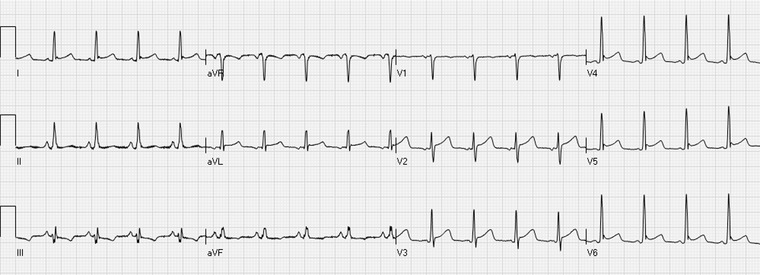12-lead ECG showing anterior STEMI with ST elevation in leads V1-V4
