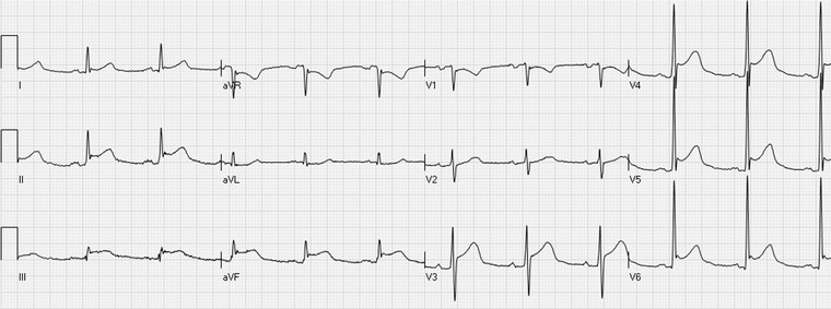 12-lead ECG showing inferior STEMI with ST elevation in leads II, III, aVF