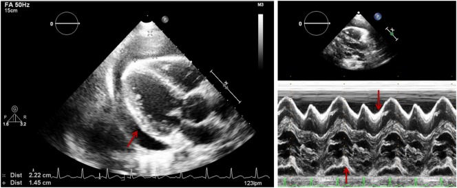 Doppler echocardiography showing respiratory variation in mitral and tricuspid valve flows indicating tamponade physiology