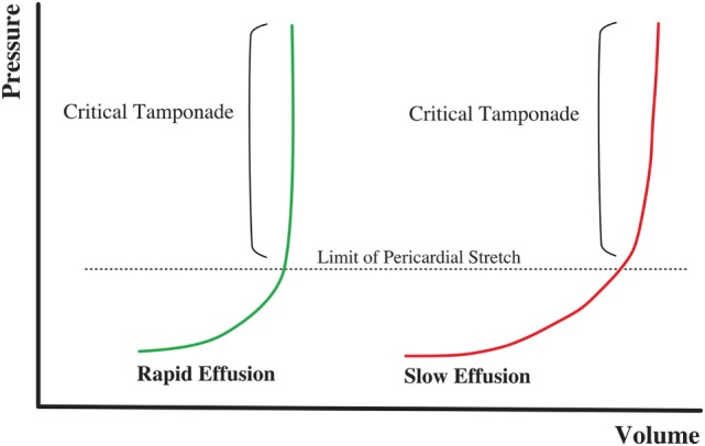 Echocardiogram showing right ventricular diastolic collapse in cardiac tamponade