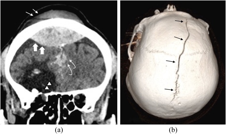 CT head showing multiple cerebral contusions with hemorrhagic foci in the temporal and frontal lobes
