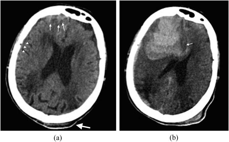 CT head showing epidural hematoma with characteristic biconvex lens-shaped hyperdense collection