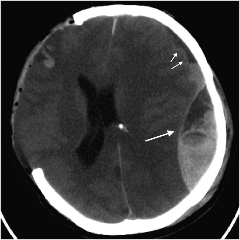 CT head showing transtentorial herniation with uncal herniation, midline shift, and effacement of basal cisterns