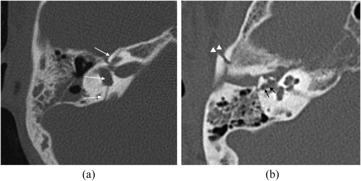 CT head showing acute subdural hematoma with crescent-shaped hyperdense collection and midline shift