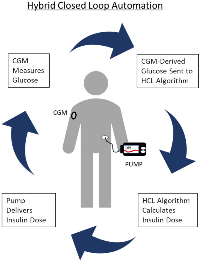 Diagram of a hybrid closed-loop automated insulin delivery system showing pump, CGM, and control algorithm