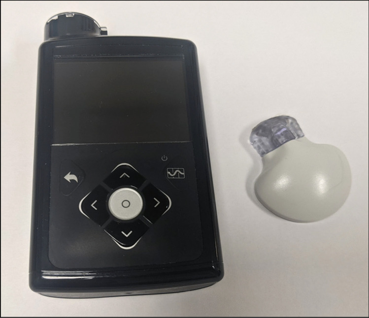 Photograph of an insulin pump system with continuous glucose monitor sensor and transmitter