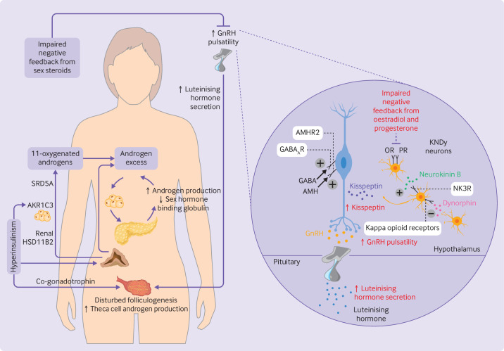 Diagram of PCOS pathophysiology showing interplay between hyperandrogenism, insulin resistance, and anovulation