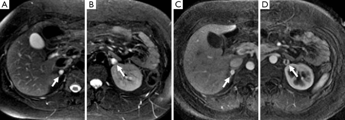 MRI images of bilateral adrenal pheochromocytomas in a VHL patient showing T2-bright lesions