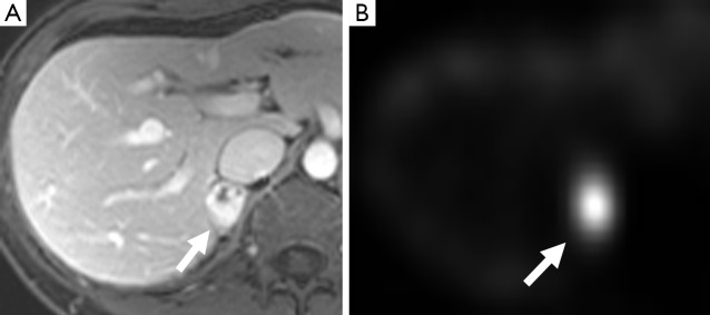MRI and MIBG scan images showing right adrenal pheochromocytoma with MIBG avidity