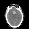 CT scan showing a pituitary macroadenoma with suprasellar extension