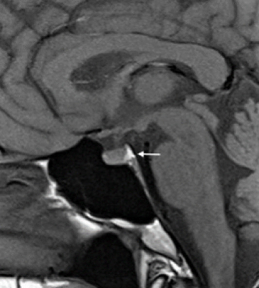 MRI of the pituitary gland showing the normal posterior pituitary bright spot on T1-weighted imaging