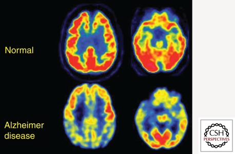 FDG-PET brain images comparing normal control with Alzheimer disease patient showing characteristic hypometabolism in temporoparietal regions