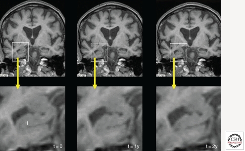 Serial coronal T1-weighted MRI studies showing progressive hippocampal atrophy over time in Alzheimer disease
