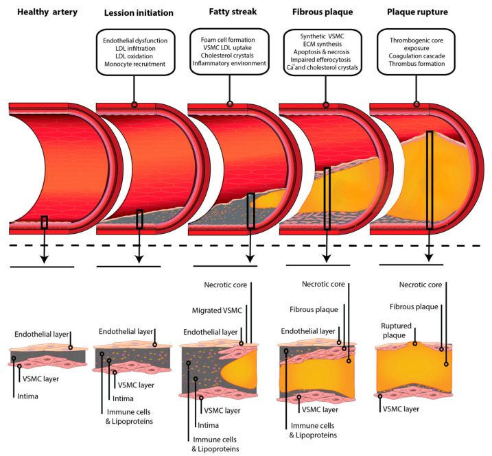 Diagram of atherosclerotic plaque formation stages showing endothelial dysfunction, foam cell formation, and plaque progression