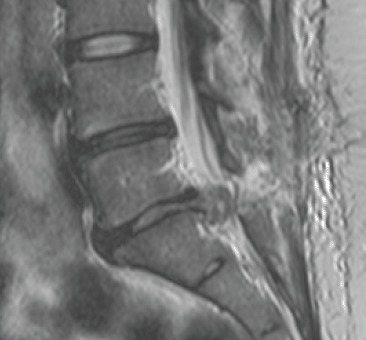 Sagittal T2-weighted MRI showing disc extrusion at L5-S1 level with compression of nerve roots